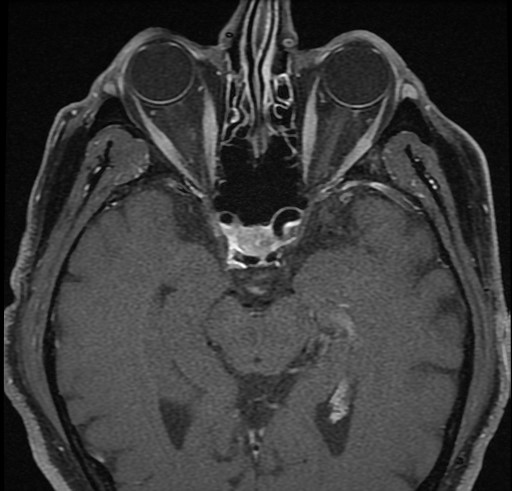 9.1.3 MRI Table - T1 Coronal