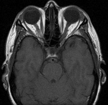 9.1.3 MRI Table - T1 Axial