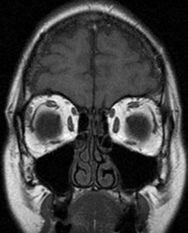 9.1.3 MRI Table - T1 Coronal