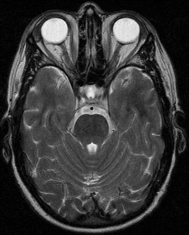 9.1.3 MRI Table - T2 Axial