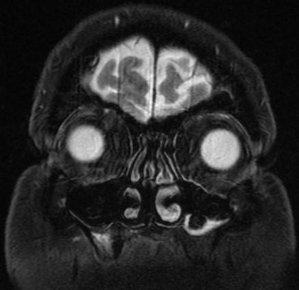 9.1.3 MRI Table - T2 Coronal