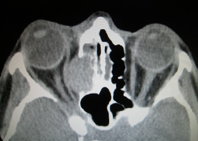 Figure 9.13.10 Mucocele (Orbital)