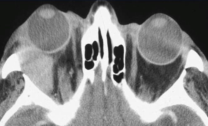 Figure 9.13.11 Pleomorphic Adenoma of the Lacrimal Gland