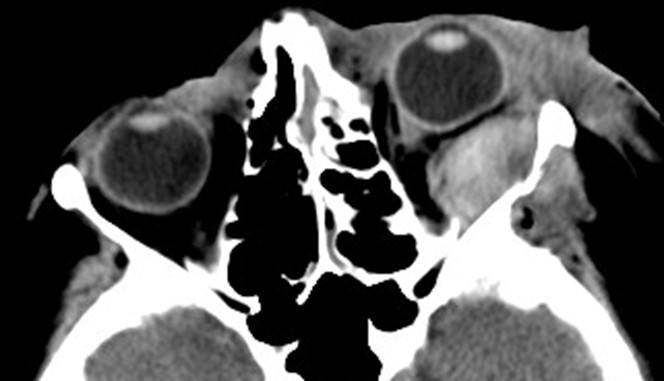 Figure 9.13.12 Retrobulbar Haemorrhage