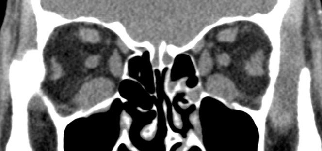 Figure 9.13.14 Thyroid Orbitopathy
