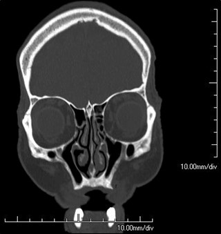 Figure 9.12.2
Bitemporal Hemianopia (Bilateral)
Bitemporal hemianopia secondary to a pituitary macroadenoma.