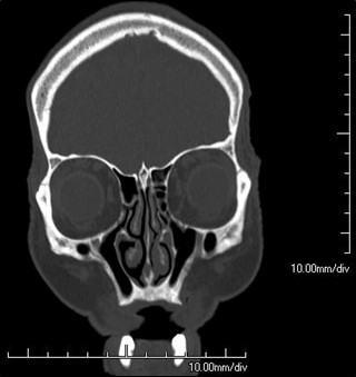 Figure 9.12.2
Bitemporal Hemianopia (Bilateral)
Bitemporal hemianopia secondary to a pituitary macroadenoma.