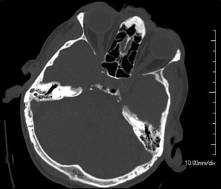 Figure 9.12.2
Bitemporal Hemianopia (Bilateral)
Bitemporal hemianopia secondary to a pituitary macroadenoma.