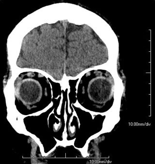 Figure 9.12.2
Bitemporal Hemianopia (Bilateral)
Bitemporal hemianopia secondary to a pituitary macroadenoma.