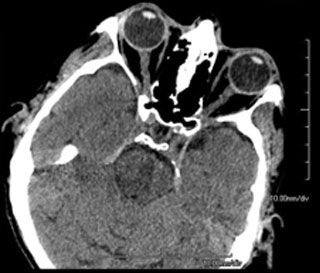 Figure 9.12.2
Bitemporal Hemianopia (Bilateral)
Bitemporal hemianopia secondary to a pituitary macroadenoma.