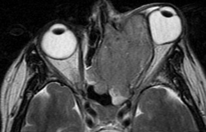 Figure 9.13.20 Nasal Carcinoma