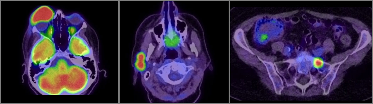 Figure 9.13.25 PET-CT Scan