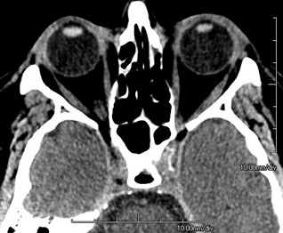 Figure 9.13.2a Non-contrast vs Contrast CT