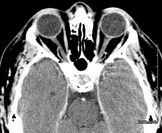 Figure 9.13.2b Non-contrast vs Contrast CT