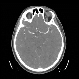 Figure 9.13.3 CT Angiography