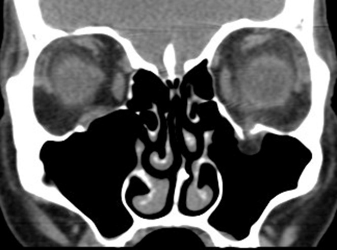 Figure 9.13.4 Blowout Fracture