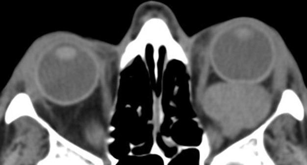 Figure 9.13.5a Cavernous Haemangioma (Orbital)