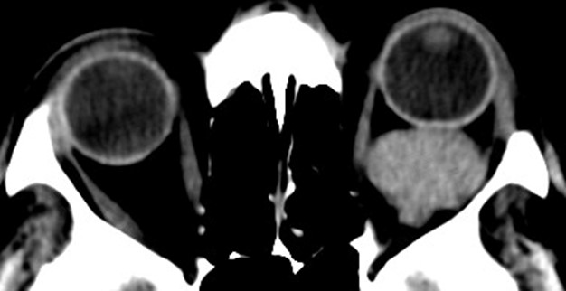 Figure 9.13.5b Cavernous Haemangioma (Orbital)