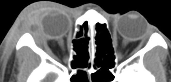 Figure 9.13.6 Cellulitis – Post Septal (Orbital)