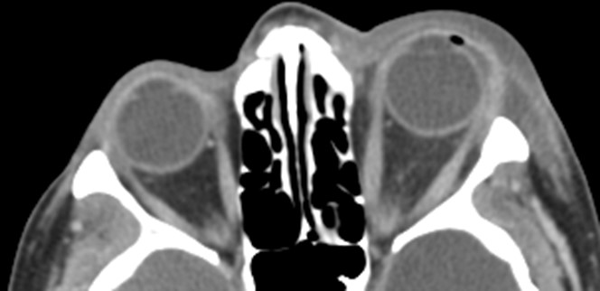 Figure 9.13.7 Cellulitis – Pre Septal