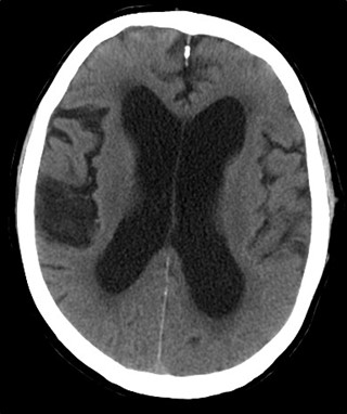 Figure 9.13.8 Hydrocephalus