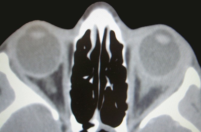 Figure 9.13.9 Idiopathic Orbital Inflammatory Disease