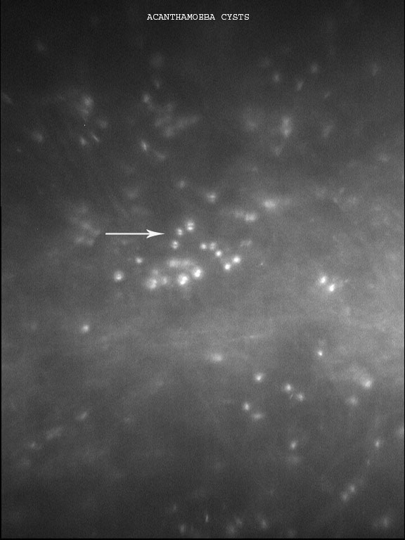 Figure 9.2.2 Acanthamoeba Keratitis