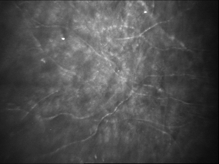 Figure 9.2.3 Fungal Keratitis