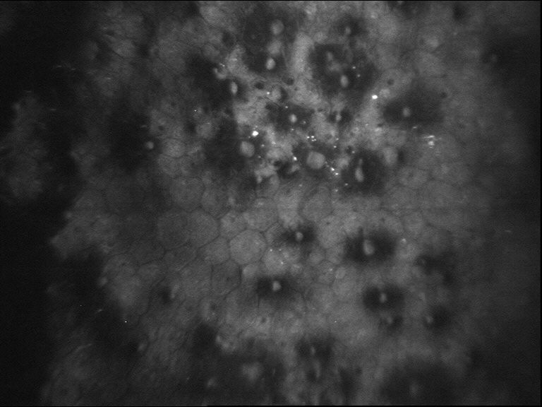 Figure 9.2.4 Fuch’s Endothelial Dystrophy