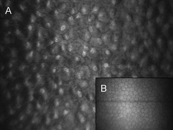 Figure 9.2.5 Iridocorneal Endothelial Syndrome