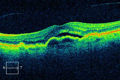 Figure 9.3.10 Choroidal New Vessel with Pigment Epithelial Detachment and Subretinal Fluid