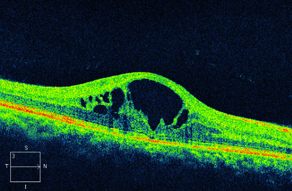 Figure 9.3.11 Cystoid Macular Oedema (Gross)