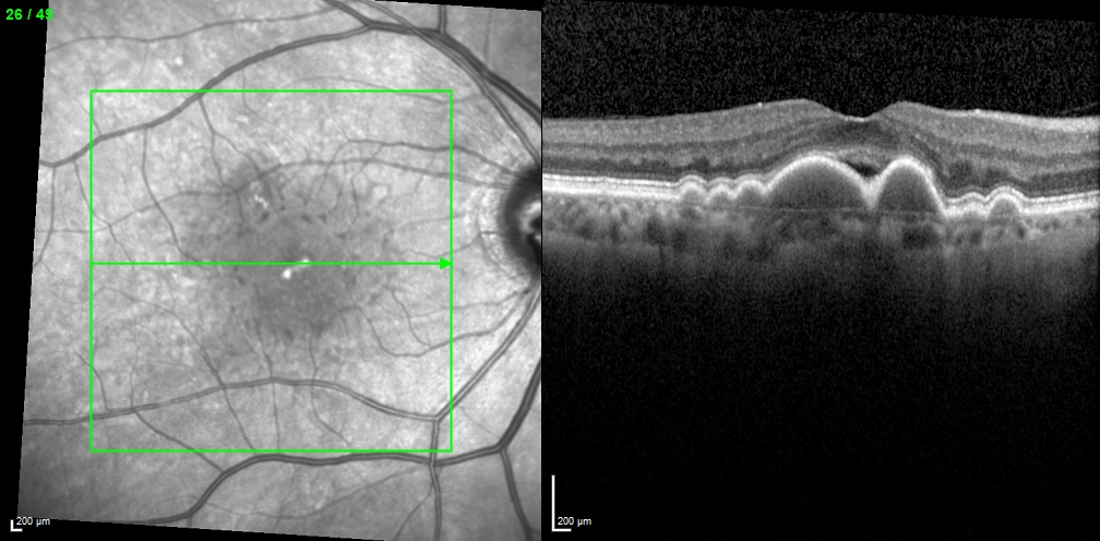 Figure 9.3.12 Drusenoid Pigment Epithelial Detachment (PED)