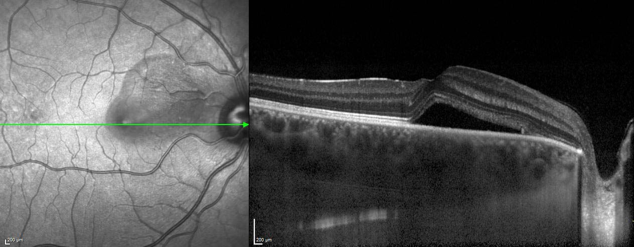 Figure 9.3.13 Enhanced Depth Imaging OCT (EDI-OCT)