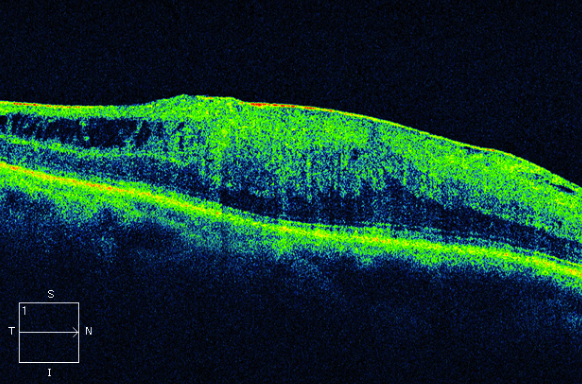 Figure 9.3.14 Epiretinal Membrane with Diffuse Retinal Oedema