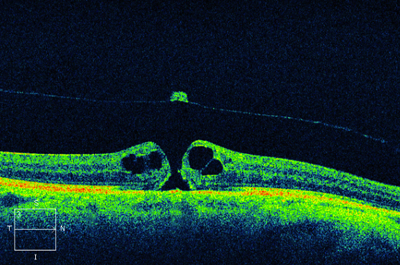 Figure 9.3.15 Full Thickness Macular Hole with Cystoid Macular Oedema and Operculum