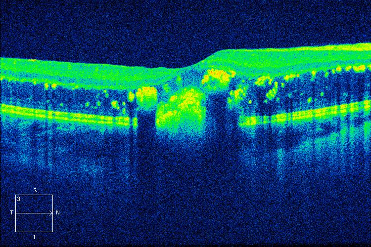 Figure 9.3.17 Hard Exudate and Retinal Oedema