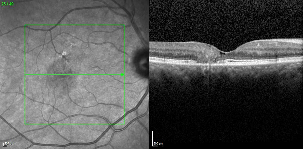 Figure 9.3.18 Macular Telangiectasia (Type 2) – “MacTel 2”