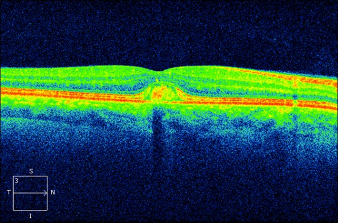 Figure 9.3.2 Adult Vitelliform Macular Degeneration