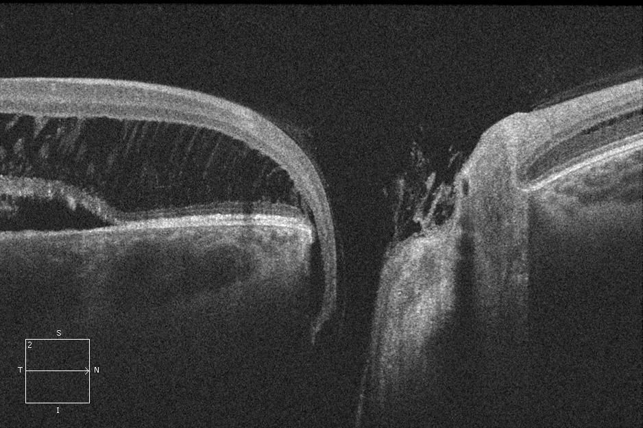 Figure 9.3.21 Optic Disc Pit Maculopathy