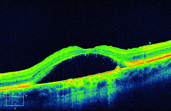 Figure 9.3.4 Central Serous Chorioretinopathy