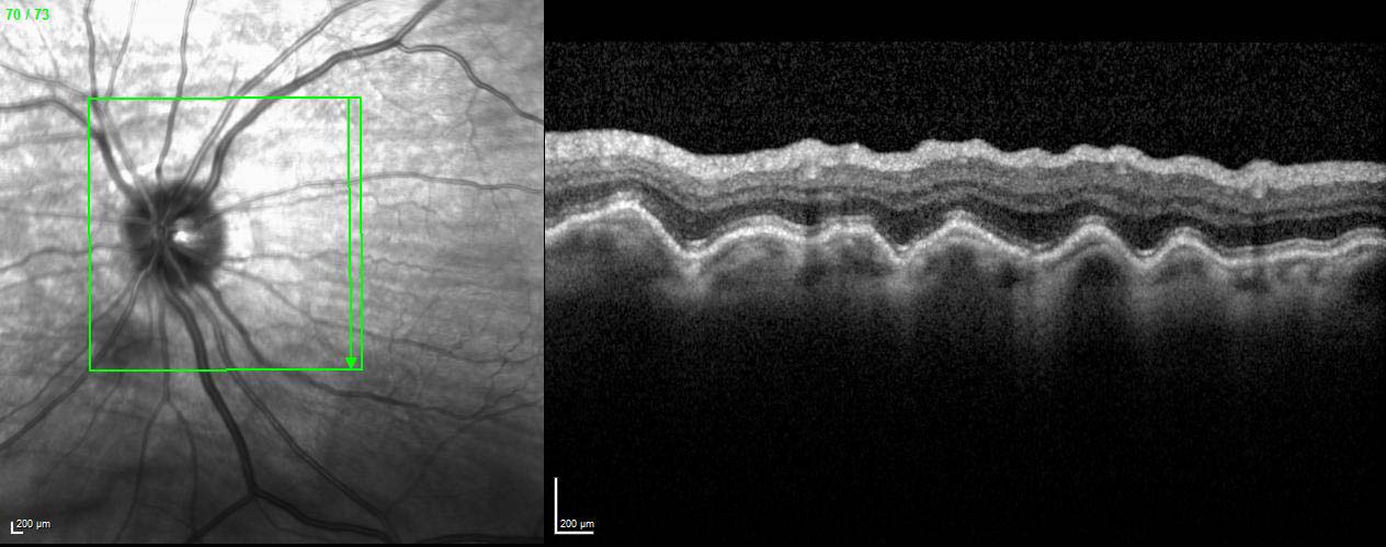 Figure 9.3.5 Choroidal Folds