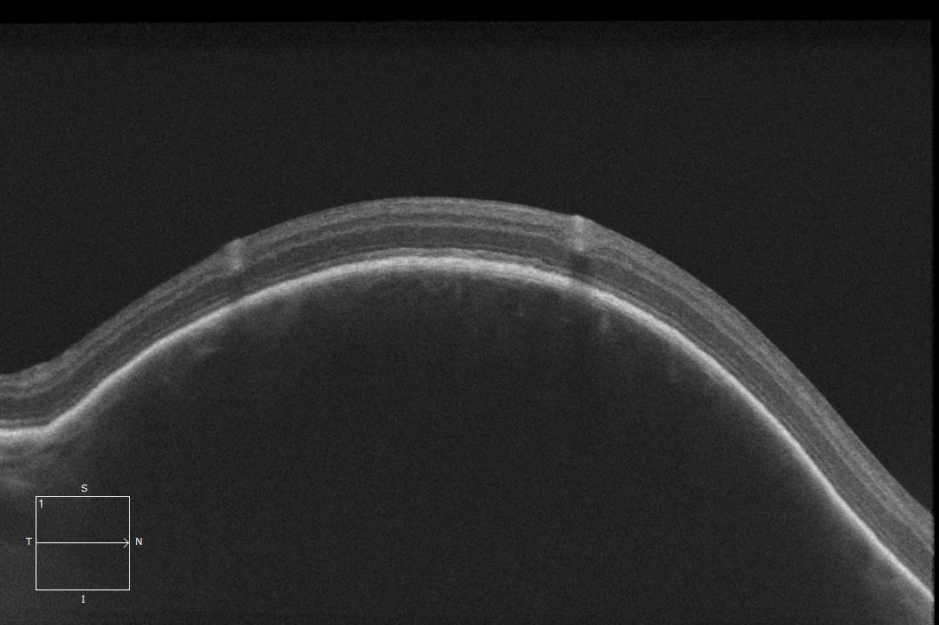 Figure 9.3.6 Choroidal Haemangioma