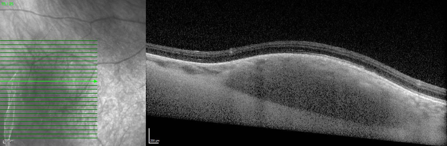 Figure 9.3.7 Choroidal Naevus (Amelanotic)