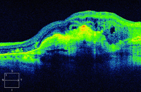 Figure 9.3.9 Choroidal New Vessel with Fibrovascular Pigment Epithelial Detachment, Outer Retinal Tubulation and Retinal Cysts