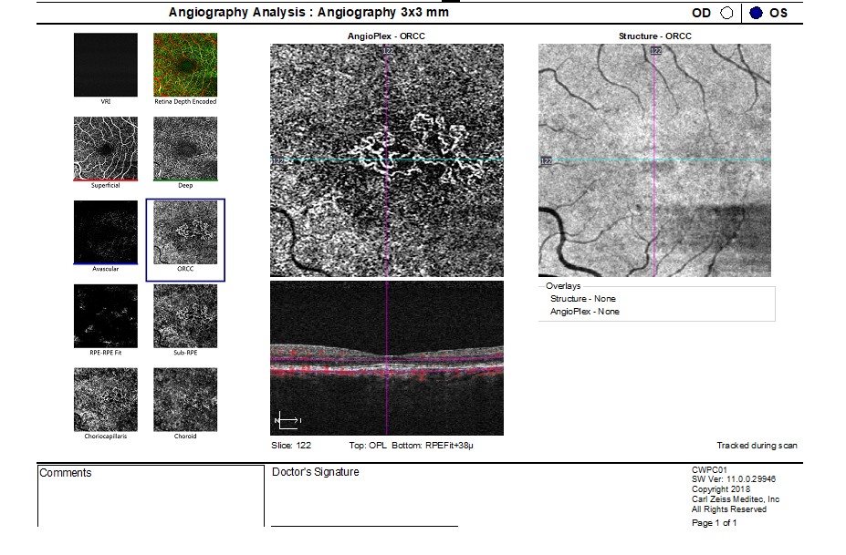 Figure 9.4.1 OCT-A displaying an Area of Type 1 (sub-RPE) NeovascularisationSsecondary to Central Serous Chorioretinopathy