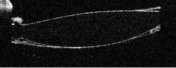 Figure 9.6.2 IOL Opacification