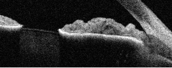 Figure 9.6.3 Iris Arterio-Venous Malformation