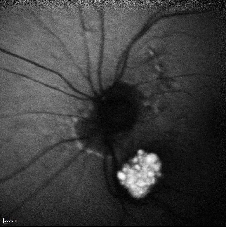 Figure 9.7.1 Astrocytic Retinal Hamartoma