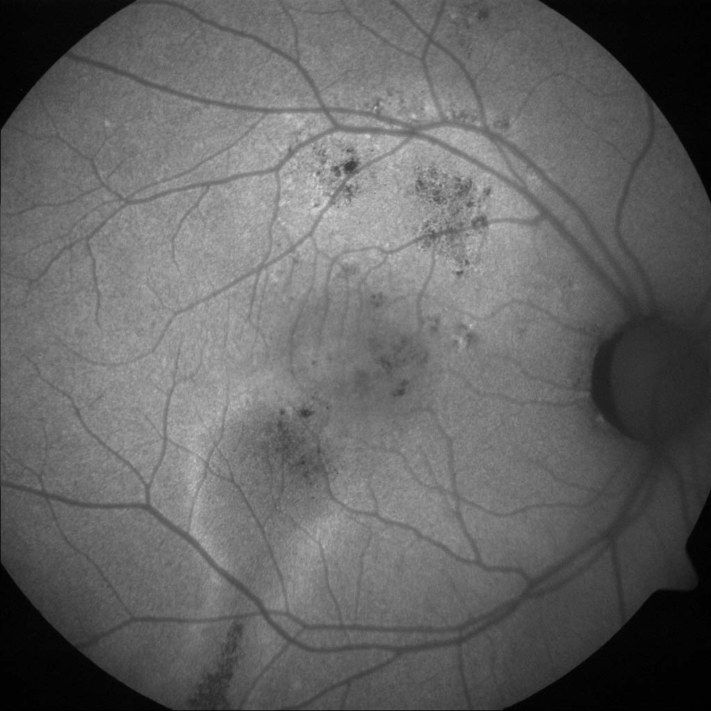 Figure 9.7.2 Central Serous Chorioretinopathy (Chronic)